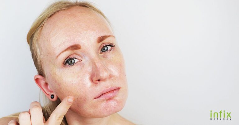 প্রাকৃতিক উপায়ে তৈলাক্ত ত্বকের যত্ন